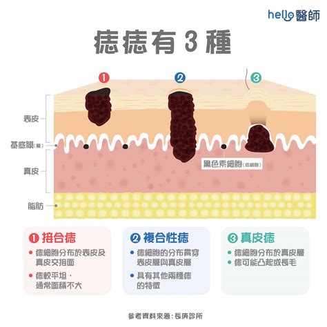 老二上有痣|痣變大、痣多或長毛會變皮膚癌？認識痣的形成與原因